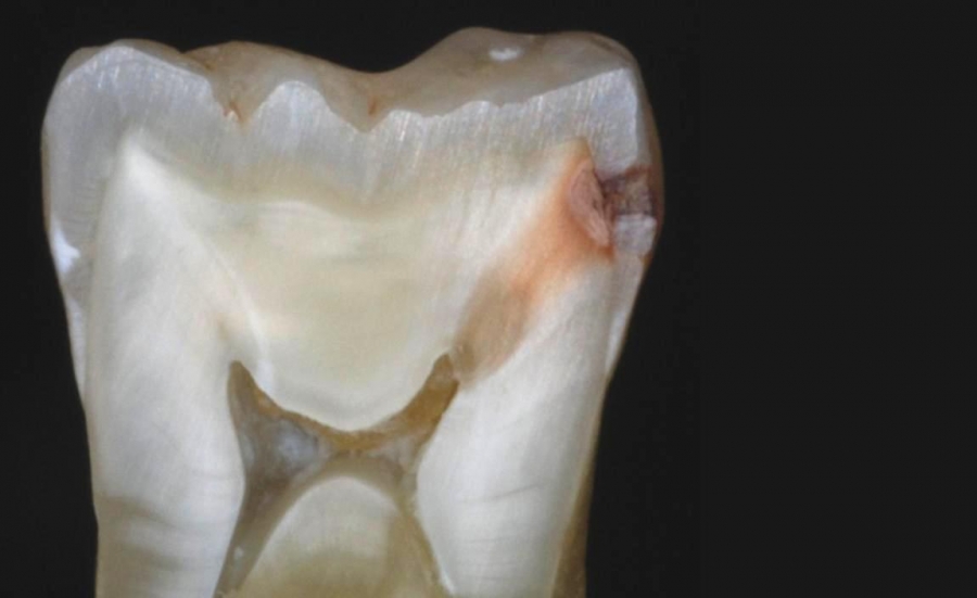 La carie dentaria: la storia, le cause, i rimedi e i consigli